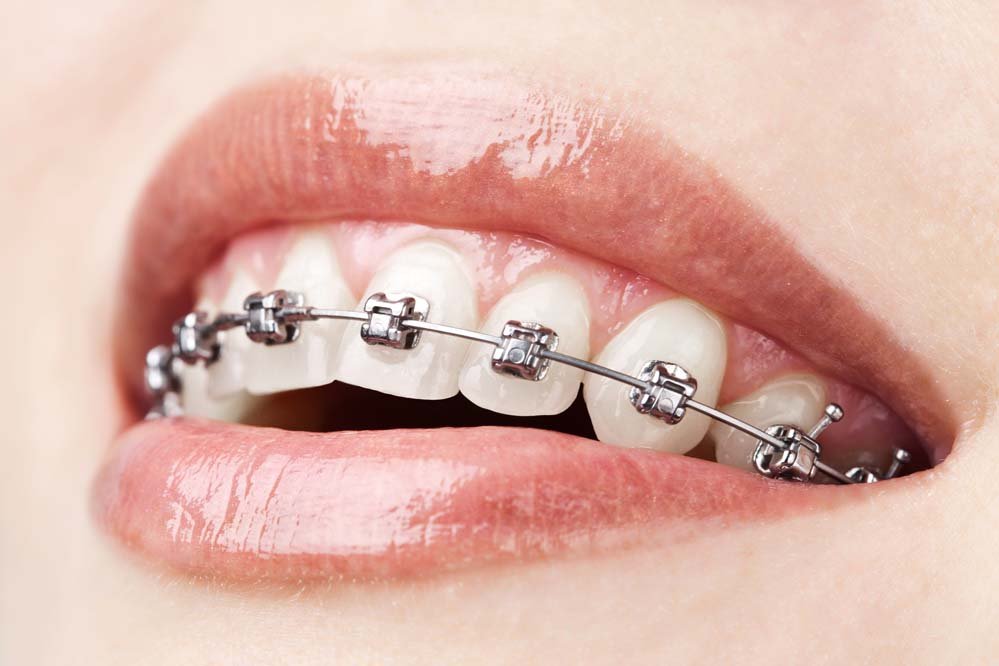 Diş Teli ile ilgili doğru bilinen 7 yanlış!