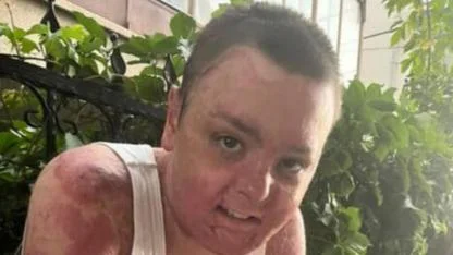 Kabusu yaşayan 14 yaşındaki çocuğun tüm vücudu yandı: Kocaeli’de tedavi edildi